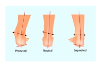 Causes and Treatment of Supination